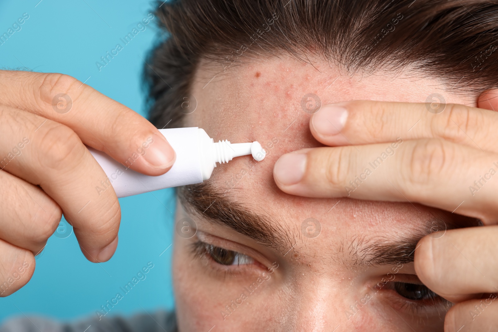 Young man with acne problem applying cream onto his face on light blue background, closeup Photo of Young man with acne problem applying cream onto his face on light blue background, closeup