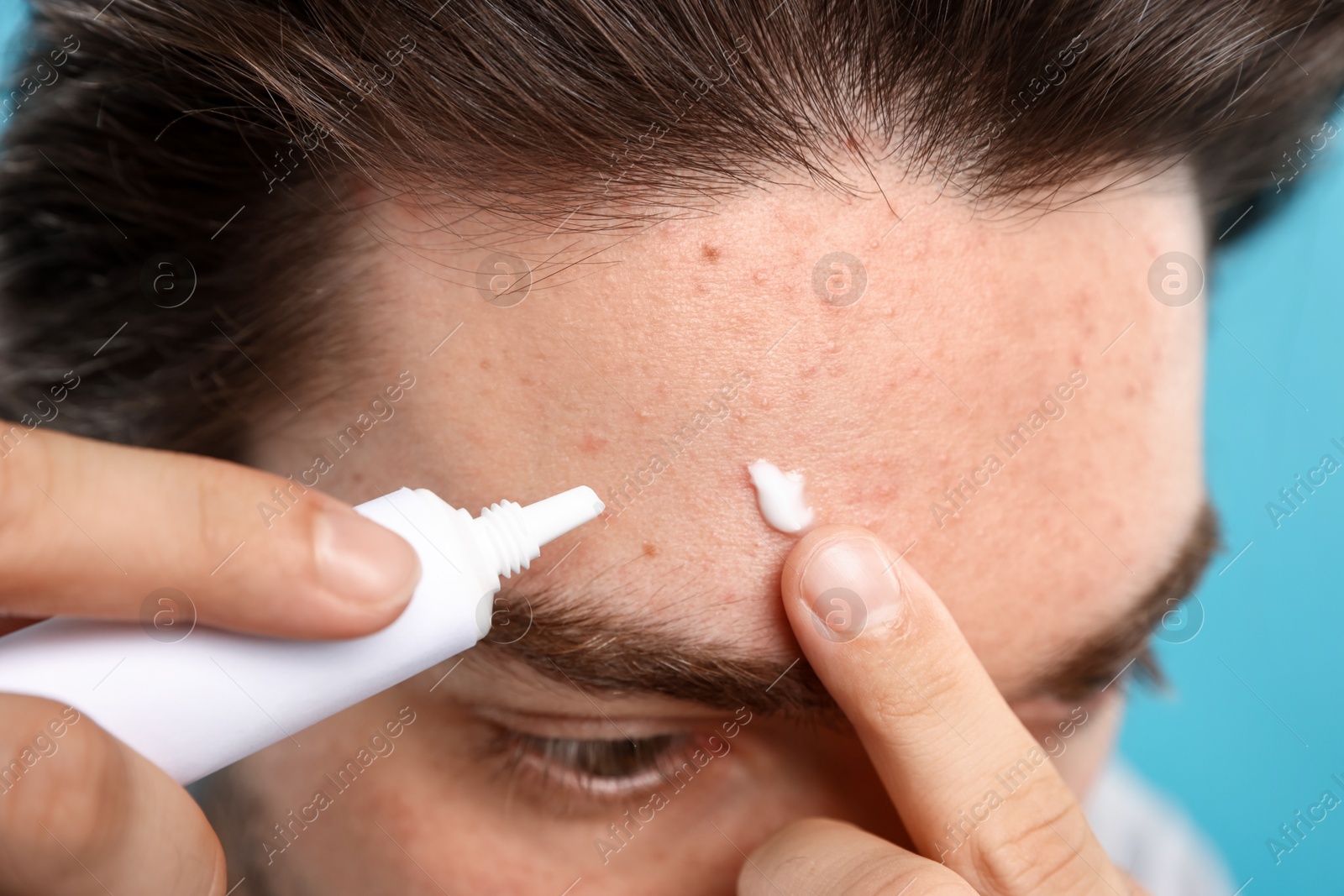 Young man with acne problem applying cream onto his face on light blue background, closeup Photo of Young man with acne problem applying cream onto his face on light blue background, closeup
