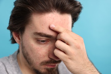 Photo of Young man with acne problem on light blue background, closeup