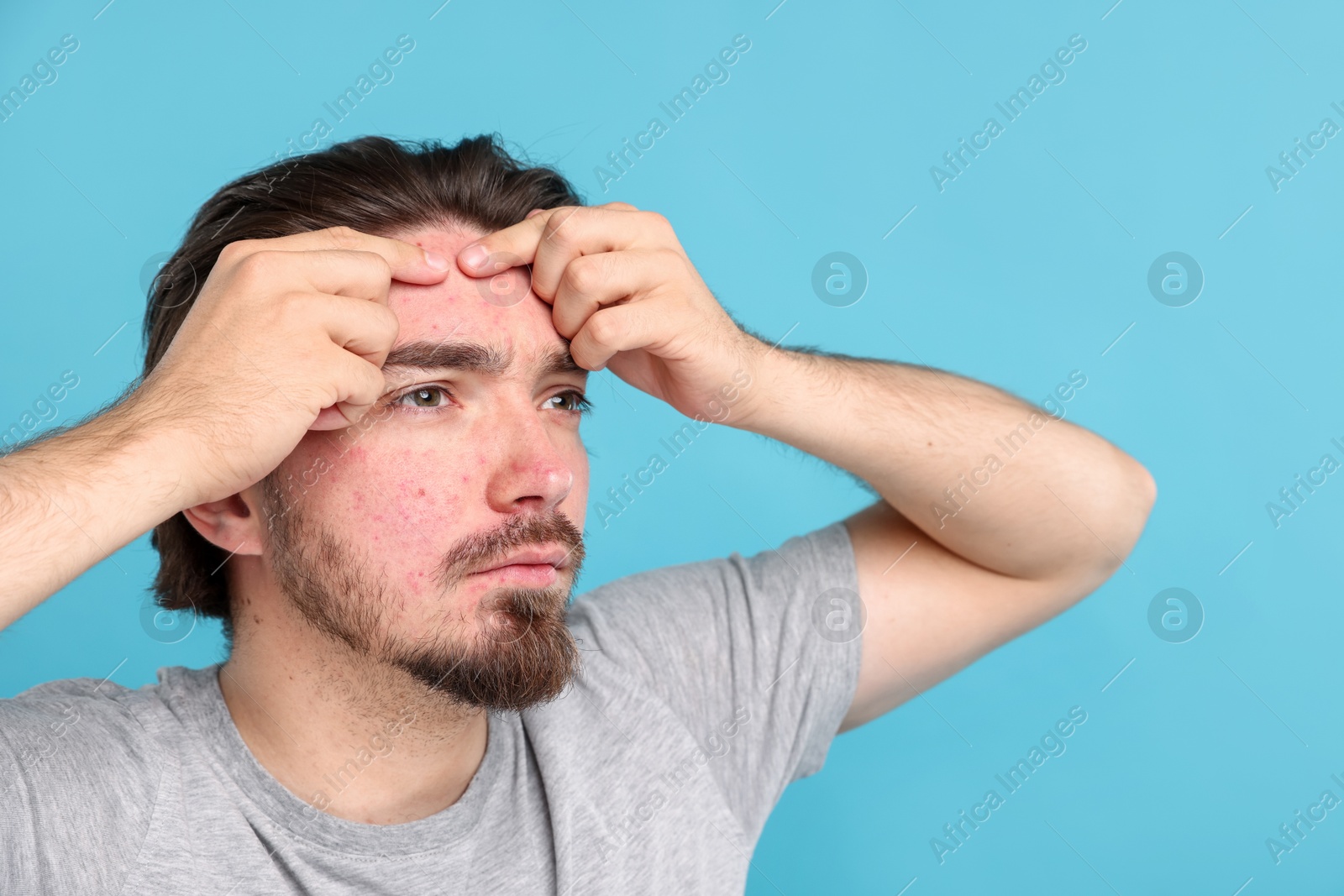 Young man with acne problem on light blue background Photo of Young man with acne problem on light blue background