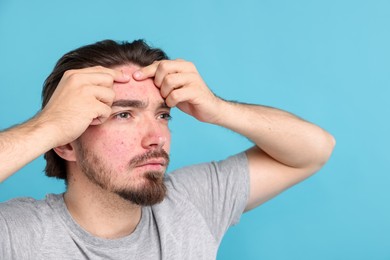 Photo of Young man with acne problem on light blue background