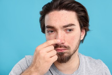Photo of Young man with acne problem on light blue background