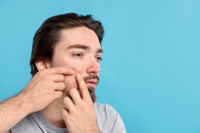 Photo of Young man with acne problem on light blue background, space for text