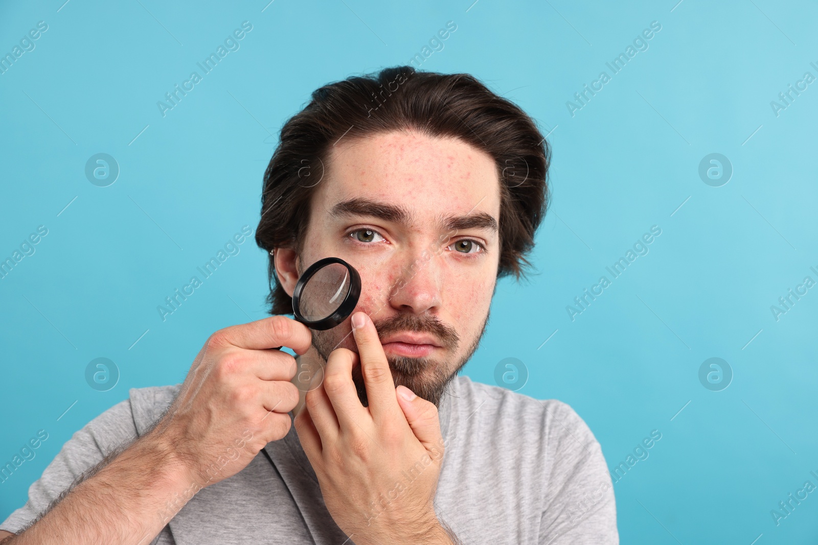 Young man with acne problem holding magnifying glass near his face on light blue background Photo of Young man with acne problem holding magnifying glass near his face on light blue background