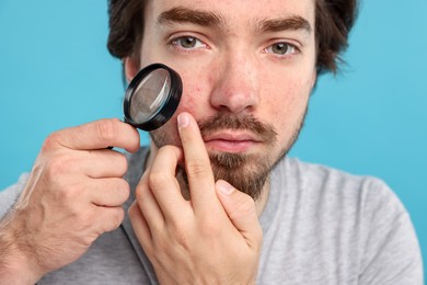 Photo of Young man with acne problem holding magnifying glass near his face on light blue background, closeup