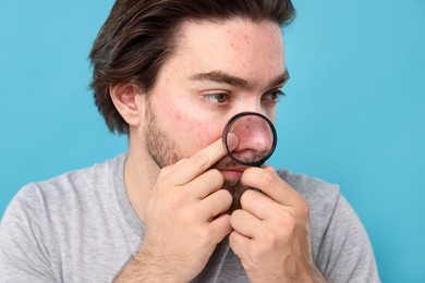 Photo of Young man with acne problem holding magnifying glass near his face on light blue background