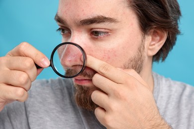 Photo of Young man with acne problem holding magnifying glass near his face on light blue background, closeup