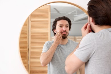 Photo of Young man with acne problem near mirror at home