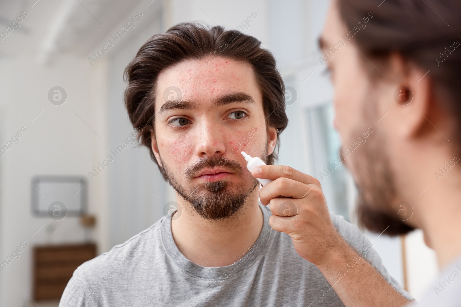 Young man with acne problem applying cream onto his face near mirror at home Photo of Young man with acne problem applying cream onto his face near mirror at home