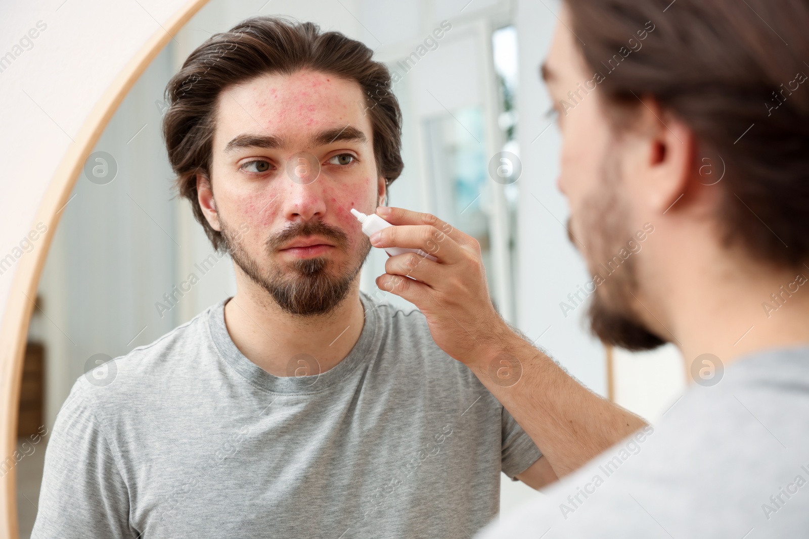 Young man with acne problem applying cream onto his face near mirror at home Photo of Young man with acne problem applying cream onto his face near mirror at home