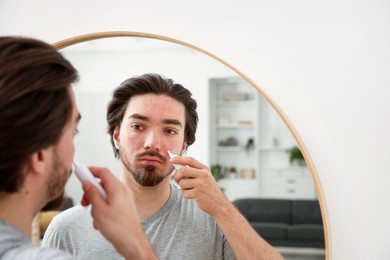 Photo of Young man with acne problem applying cream onto his face near mirror at home