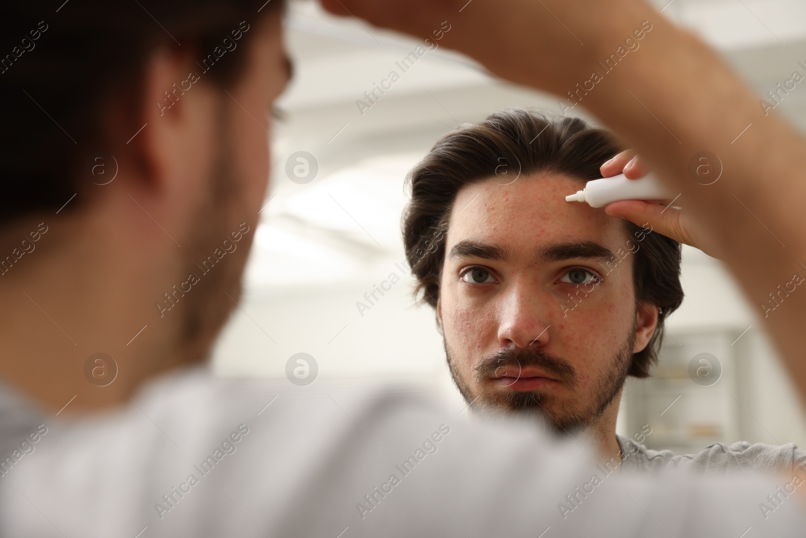 Young man with acne problem applying cream onto his face near mirror at home Photo of Young man with acne problem applying cream onto his face near mirror at home