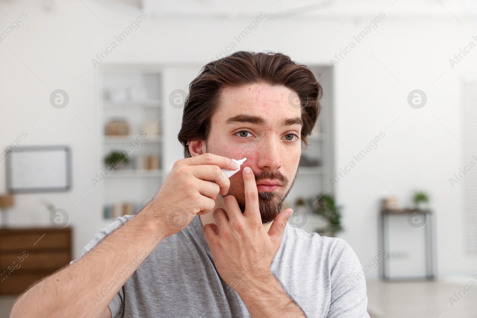 Young man with acne problem applying cream onto his face at home Photo of Young man with acne problem applying cream onto his face at home