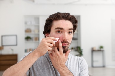 Photo of Young man with acne problem applying cream onto his face at home