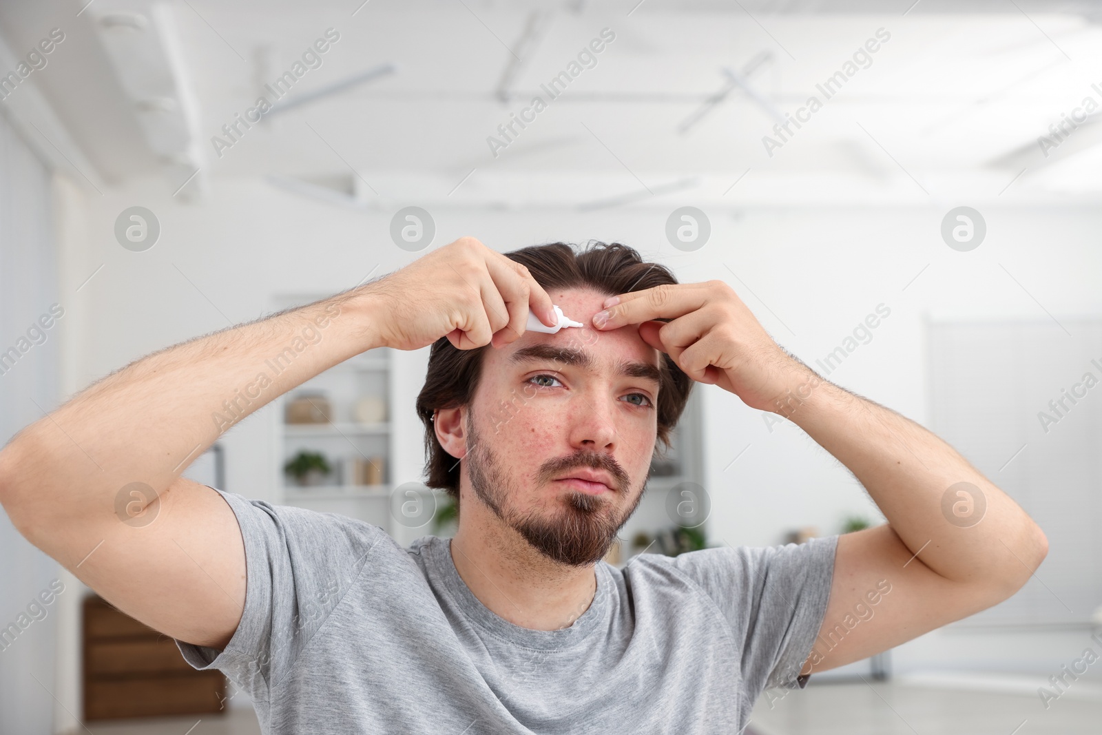 Young man with acne problem applying cream onto his face at home Photo of Young man with acne problem applying cream onto his face at home