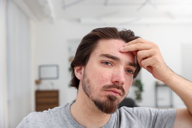 Photo of Young man with acne problem at home