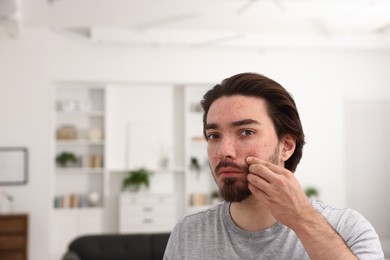 Photo of Young man with acne problem at home. Space for text