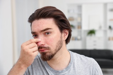 Photo of Young man with acne problem at home