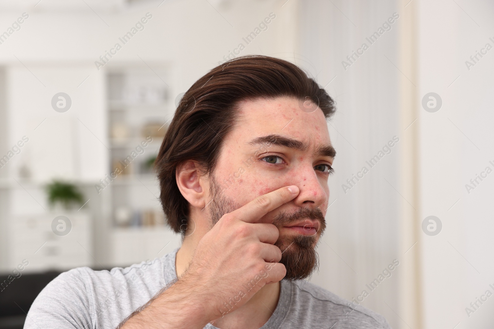 Young man with acne problem at home Photo of Young man with acne problem at home