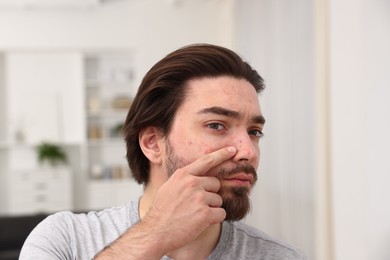 Photo of Young man with acne problem at home