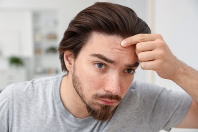 Photo of Young man with acne problem at home, closeup