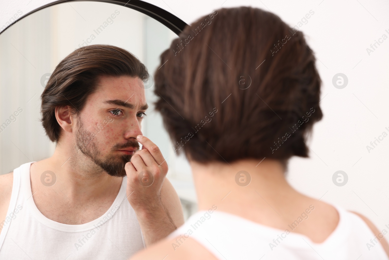 Young man with acne problem near mirror at home Photo of Young man with acne problem near mirror at home