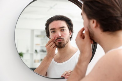 Photo of Young man with acne problem near mirror at home