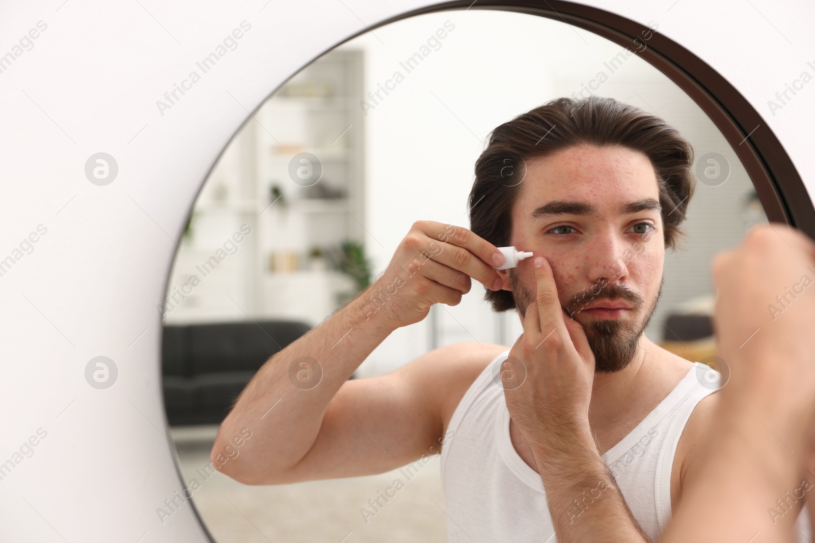 Young man with acne problem applying cream onto his face near mirror at home Photo of Young man with acne problem applying cream onto his face near mirror at home
