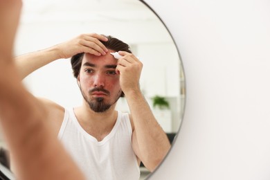 Photo of Young man with acne problem applying cream onto his face near mirror at home, space for text