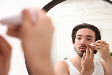 Photo of Young man with acne problem applying cream onto his face near mirror at home