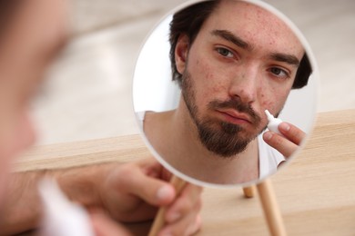 Photo of Young man with acne problem applying cream onto his face near mirror at table indoors