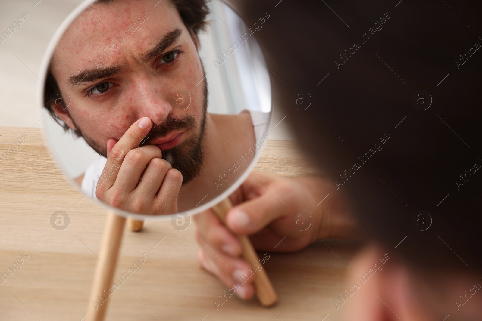 Young man with acne problem looking at mirror at table indoors Photo of Young man with acne problem looking at mirror at table indoors