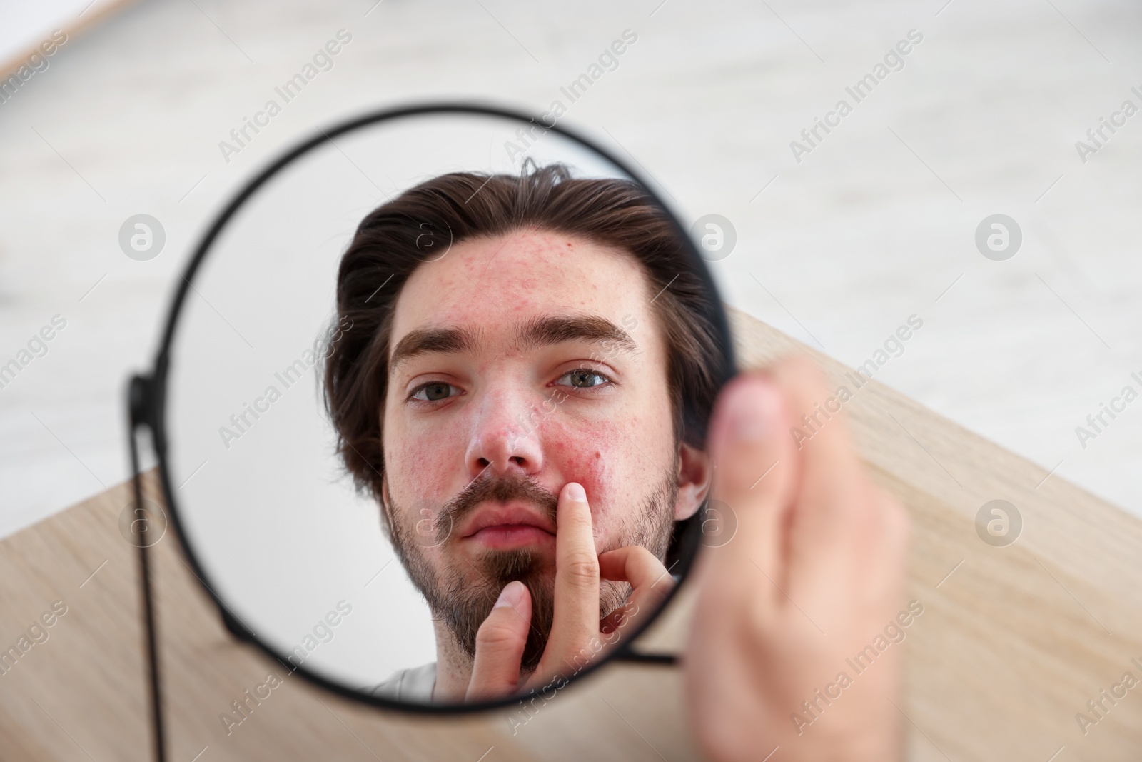 Young man with acne problem looking at mirror at table indoors Photo of Young man with acne problem looking at mirror at table indoors