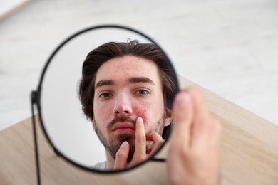 Photo of Young man with acne problem looking at mirror at table indoors