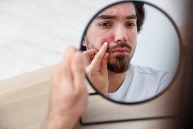 Photo of Young man with acne problem looking at mirror at table indoors