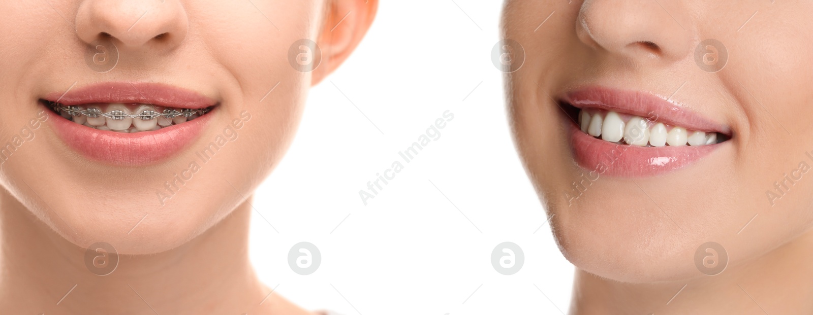 Image of Dental braces for straightening teeth. Collage with photos of smiling woman on white background, before and after
