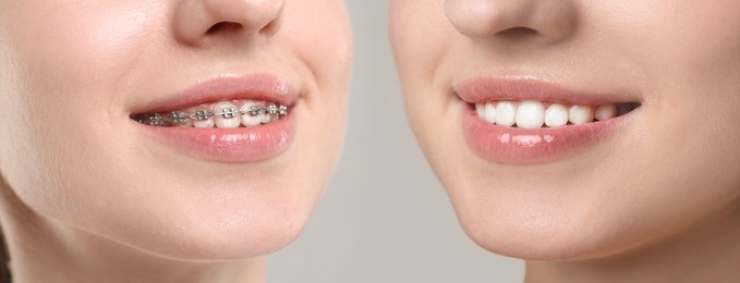 Image of Woman showing teeth while and after using dental braces, closeup. Collage with photos on grey background