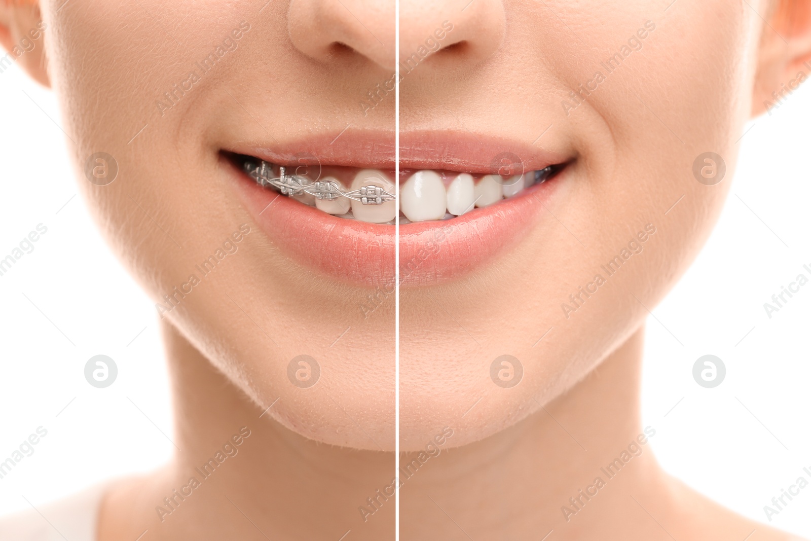 Image of Dental braces for straightening teeth. Collage with before and after photo of smiling woman on white background, closeup