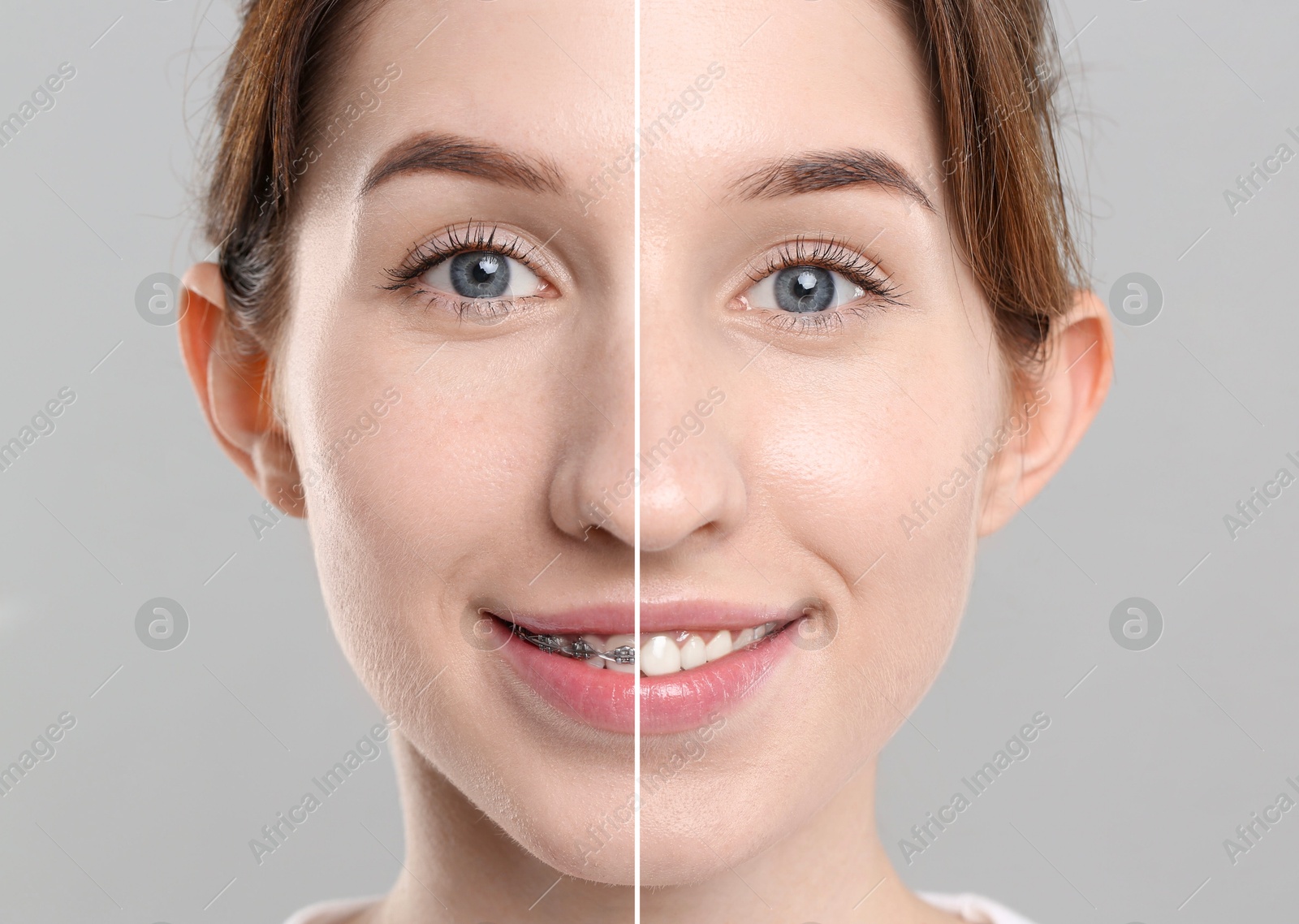 Image of Dental braces for straightening teeth. Collage with before and after photo of smiling woman on grey background, closeup