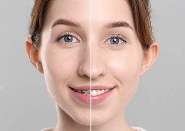 Image of Dental braces for straightening teeth. Collage with before and after photo of smiling woman on grey background, closeup