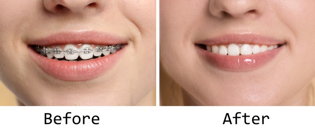 Image of Woman showing teeth while and after using dental braces, closeup. Collage of photos