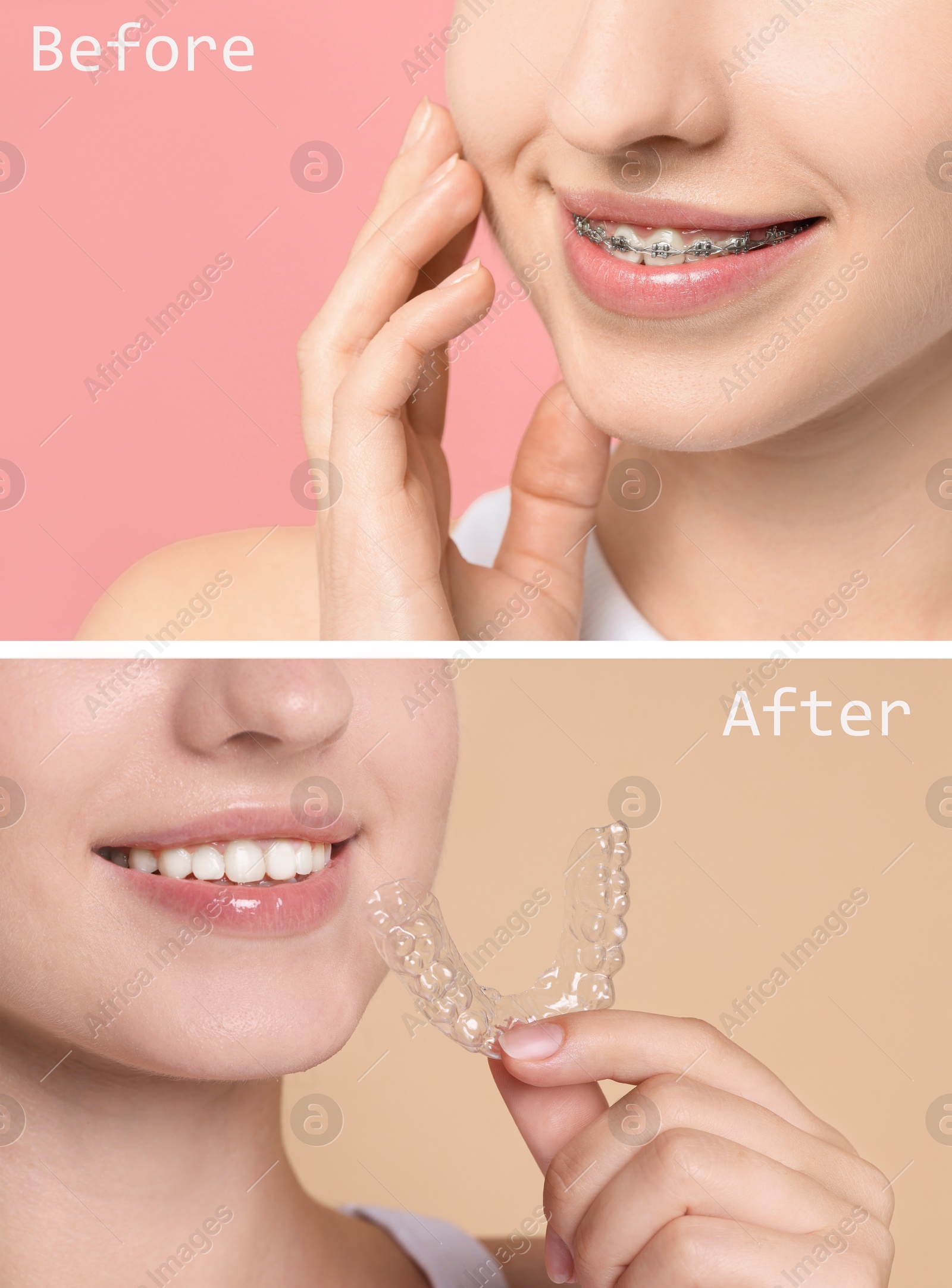 Image of Dental braces for straightening teeth. Collage with before and after photo of smiling woman on color background, closeup
