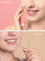 Image of Dental braces for straightening teeth. Collage with before and after photo of smiling woman on color background, closeup