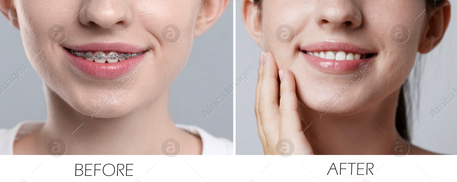 Image of Woman showing teeth while and after using dental braces, closeup. Collage of photos on grey background
