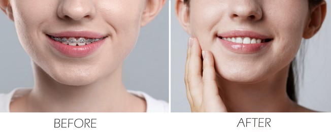 Image of Woman showing teeth while and after using dental braces, closeup. Collage of photos on grey background