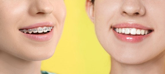 Image of Dental braces for straightening teeth. Collage with before and after photo of smiling woman on yellow background, closeup
