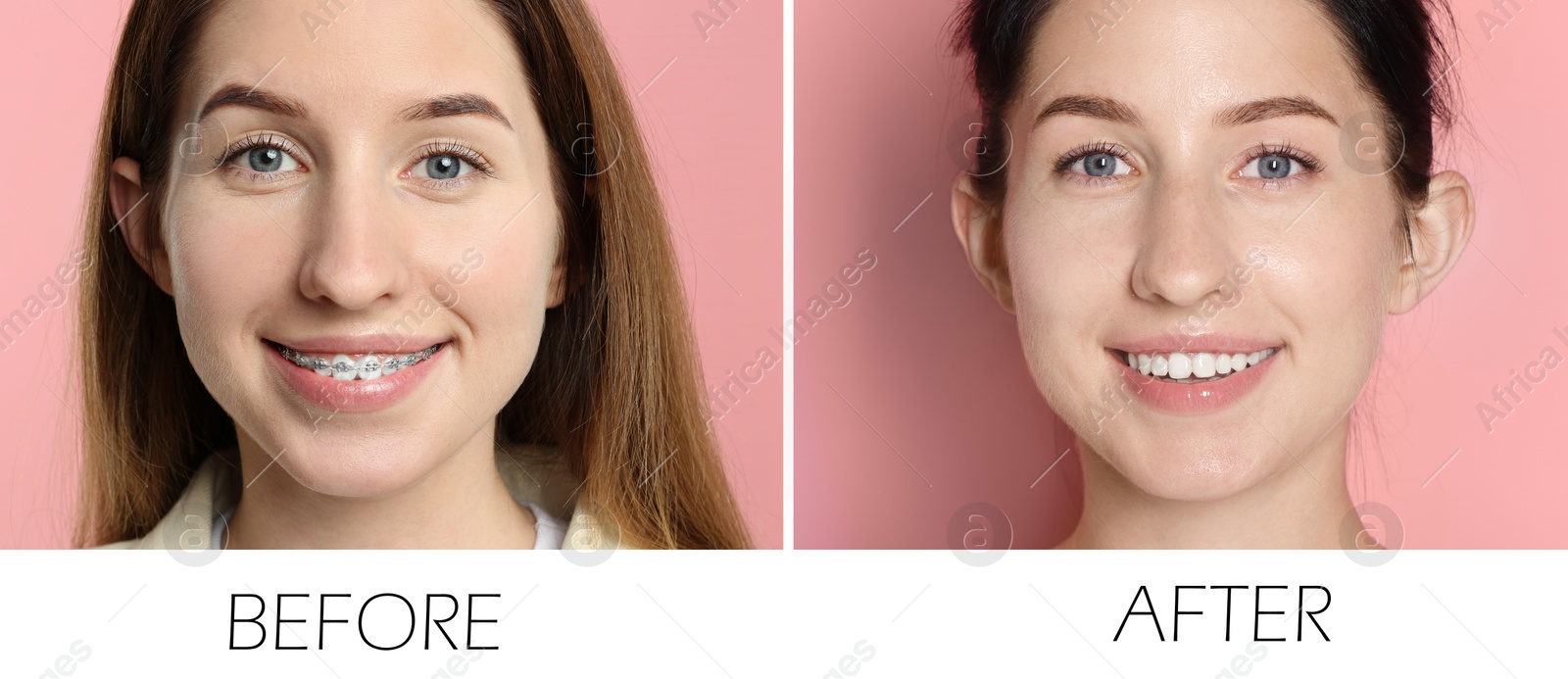 Image of Collage with photos of woman with dental braces and perfect teeth on pink background. Before and after