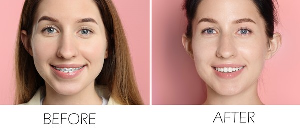 Image of Collage with photos of woman with dental braces and perfect teeth on pink background. Before and after