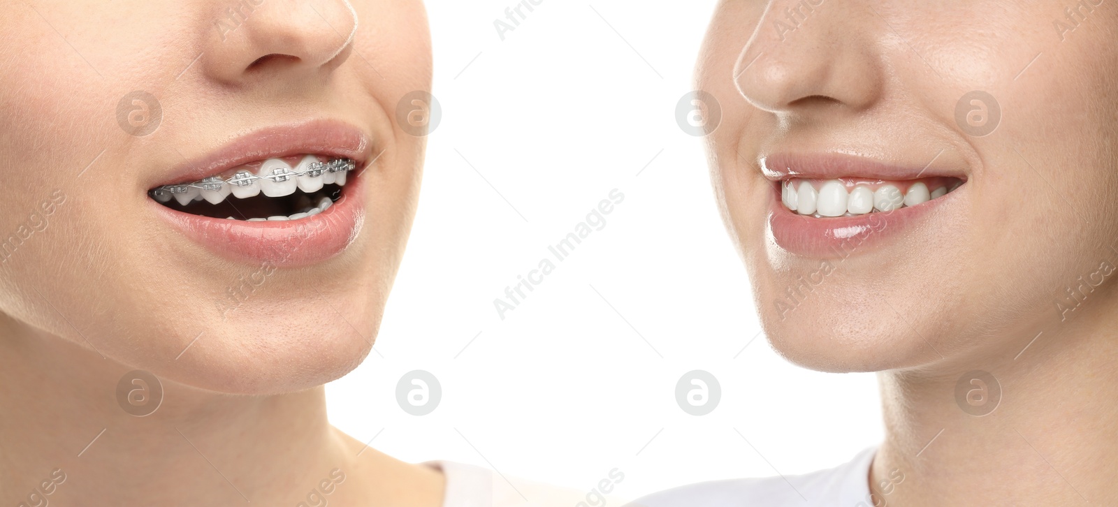 Image of Woman showing perfect teeth as result of using dental braces on white background, closeup. Collage with before and after photos