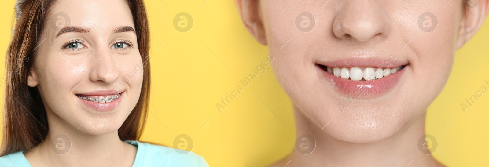 Image of Woman showing perfect teeth as result of using dental braces on yellow background, closeup. Collage with before and after photos